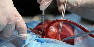 Beitragsbild des Blogbeitrags Die molekulare Signatur könnte mechanistisch mit dem Blutungsrisiko nach einer Herzoperation zusammenhängen 