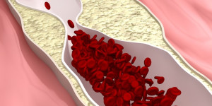 Beitragsbild des Blogbeitrags Die Exposition gegenüber Rauch aus dritter Hand erhöht die Biomarker, die mit der Entstehung von Hautkrankheiten in Zusammenhang stehen
