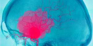 Beitragsbild des Blogbeitrags Forscher entwickeln ein mathematisches Modell zur Vorhersage des Aneurysma-Rupturrisikos