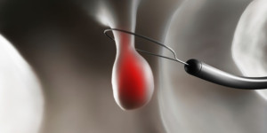 Beitragsbild des Blogbeitrags Koloskopie-Screening ist weniger wirksam, um zu verhindern, dass Patienten an Darmkrebs sterben
