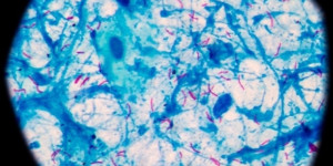 Beitragsbild des Blogbeitrags Oxford Immunotec von PerkinElmer erhält die US-amerikanische FDA-Zulassung für T-Cell Select zur Automatisierung der klinisch überlegenen Tuberkuloseerkennung