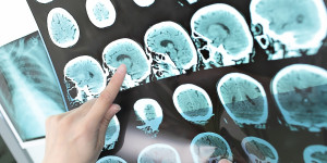 Beitragsbild des Blogbeitrags Welche genetischen Zusammenhänge gibt es bei der Pathogenese von Schlaganfällen zwischen verschiedenen Abstammungsgruppen?