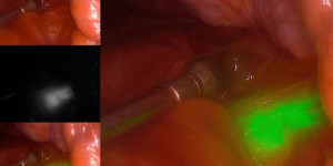 Beitragsbild des Blogbeitrags Eine genauere Lungenknotenbiopsie: Kombination von formempfindlicher Bronchoskopie mit mobiler 3D-Bildgebung