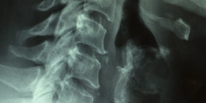 Beitragsbild des Blogbeitrags Schilddrüsenunterfunktion: Diagnose und Behandlung