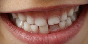Beitragsbild des Blogbeitrags Unsichtbar, leicht und effektiv – moderne Zahnkorrekturen 