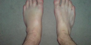 Beitragsbild des Blogbeitrags Restless-Legs-Syndrom alternativ behandeln