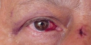 Beitragsbild des Blogbeitrags Natürliche Behandlung einer Bindehautentzündung (Konjunktivitis) 
