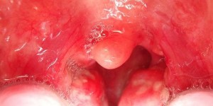 Beitragsbild des Blogbeitrags Eitrige Angina – was hilft?