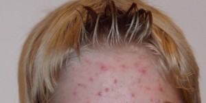 Beitragsbild des Blogbeitrags Akne – Der natürliche Weg der Heilung