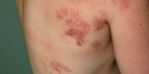 Beitragsbild des Blogbeitrags Entzündungen natürlich behandeln