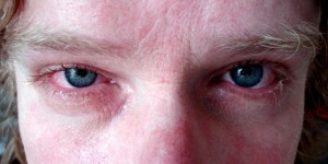 Beitragsbild des Blogbeitrags Allergien mit Hilfe der Natur lindern und heilen