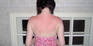 Beitragsbild des Blogbeitrags Natürliche Hilfe bei Sonnenbrand